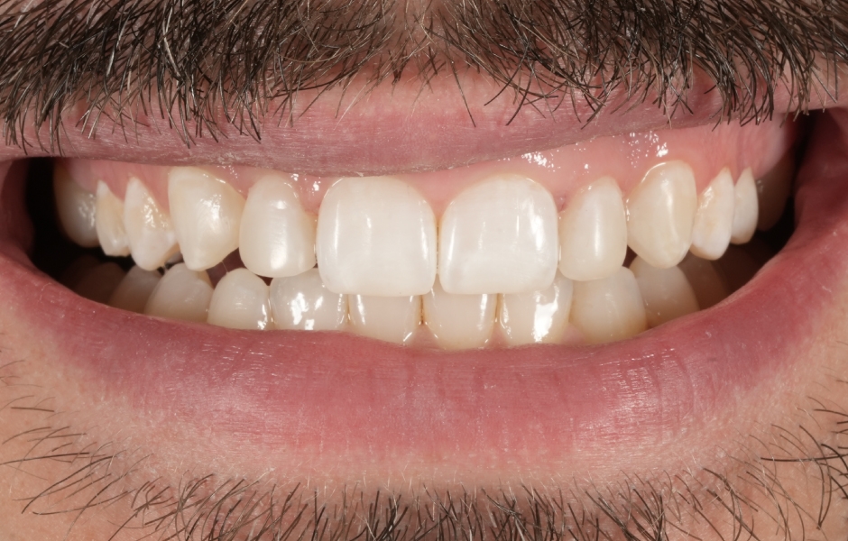 Obr. 6g: Pooperační pohled na úsměv (kontrolní návštěva).