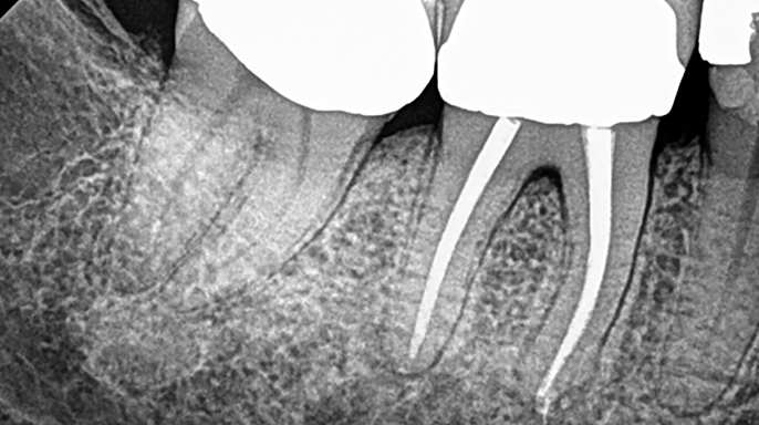 Reendodontické ošetření – úspěch s BioRoot Flow Reendodontické ošetření – úspěch s BioRoot Flow