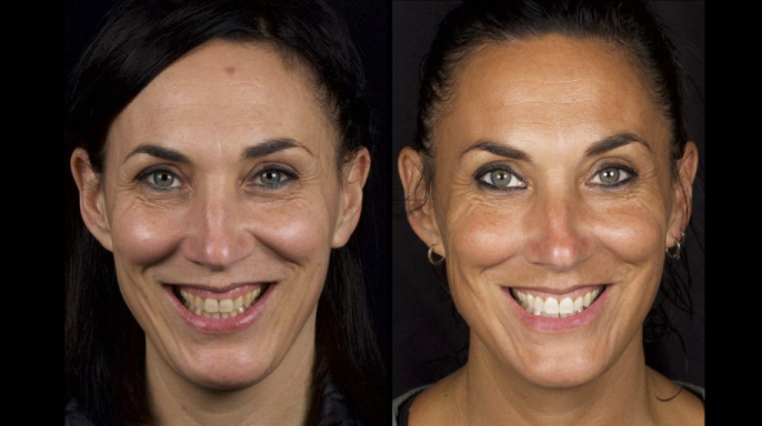 Digitální prodloužení korunky a domácí bělení zubů Digitální prodloužení korunky a domácí bělení zubů