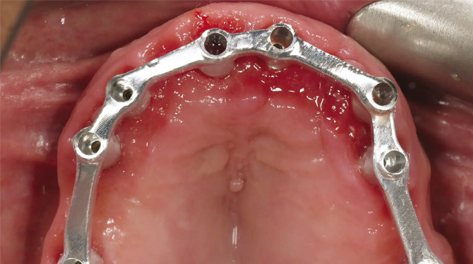 Nový digitální pracovní postup pro celkovou rehabilitaci čelistního oblouku Nový digitální pracovní postup pro celkovou rehabilitaci čelistního oblouku