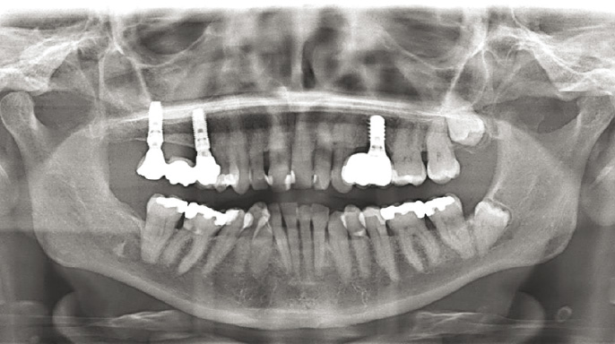 Implantologická rehabilitace u pacientů s aspergilovou sinusitidou Implantologická rehabilitace u pacientů s aspergilovou sinusitidou