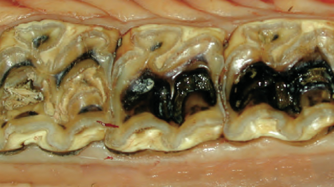 Restorativní ošetření infundibulárních kazů Restorativní ošetření infundibulárních kazů