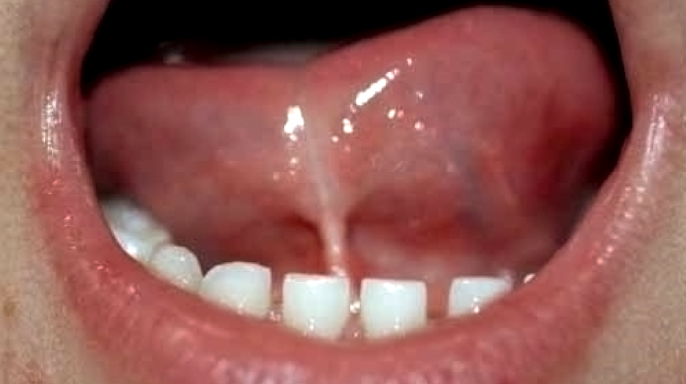 Restriktivní frenulum linguae jako rizikový faktor pro cévní onemocnění mozku Restriktivní frenulum linguae jako rizikový faktor pro cévní onemocnění mozku