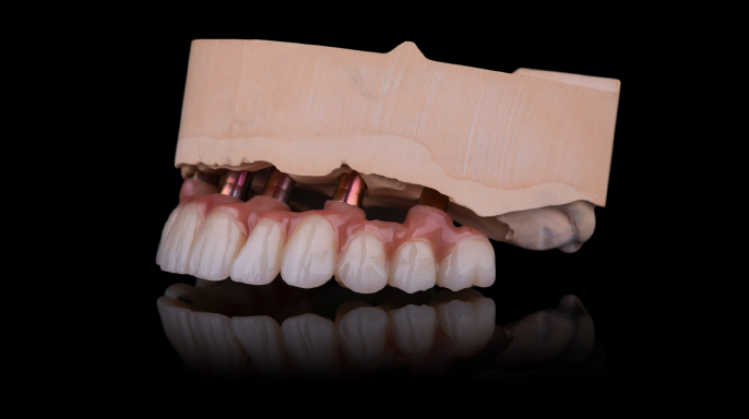 Implantáty nesená moderní komplexní rekonstrukce Implantáty nesená moderní komplexní rekonstrukce