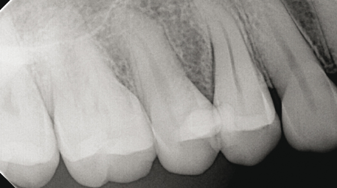 Jak diagnostikovat a endodonticky ošetřovat prasklé zuby Jak diagnostikovat a endodonticky ošetřovat prasklé zuby