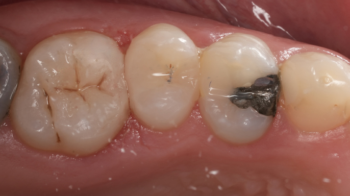 Inovativní dentální kompozitum: univerzální použití a zefektivnění výplňové terapie v klinické praxi Inovativní dentální kompozitum: univerzální použití a zefektivnění výplňové terapie v klinické praxi