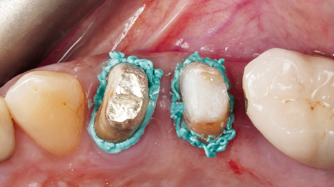 Management měkkých tkání s použitím přípravku RetraXil při protetické rekonstrukci zubů 24 a 25 Management měkkých tkání s použitím přípravku RetraXil při protetické rekonstrukci zubů 24 a 25