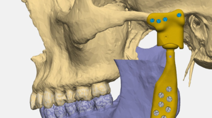 Má chirurgická léčba smysl? Aneb jaké je místo chirurgické terapie onemocnění čelistního kloubu v současnosti. Má chirurgická léčba smysl? Aneb jaké je místo chirurgické terapie onemocnění čelistního kloubu v současnosti.