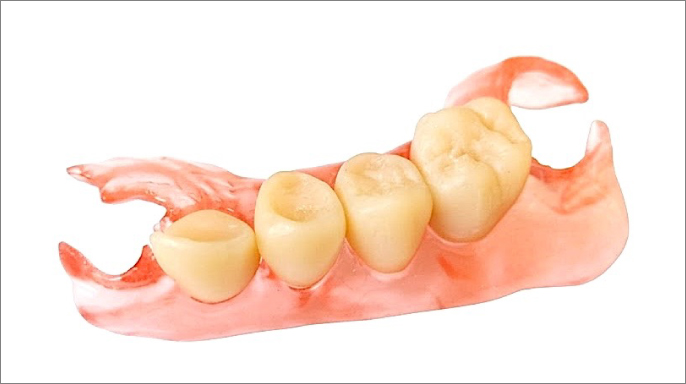 Mezerník Acetal a mezerník 3D tisk: nové možnosti snímatelných náhrad Mezerník Acetal a mezerník 3D tisk: nové možnosti snímatelných náhrad