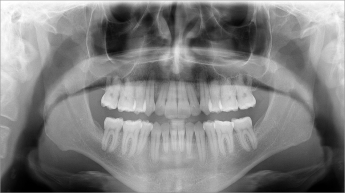 Léčba závažného frontálního otevřeného skusu pomocí průhledných alignerů Ordoline a mezičelistních elastických tahů III. třídy bez skeletálního kotvení Léčba závažného frontálního otevřeného skusu pomocí průhledných alignerů Ordoline a mezičelistních elastických tahů III. třídy bez skeletálního kotvení