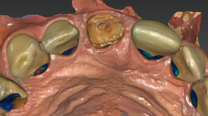 Zjednodušení okamžité implantace a následné rekonstrukce ve frontálním úseku horní čelisti Zjednodušení okamžité implantace a následné rekonstrukce ve frontálním úseku horní čelisti