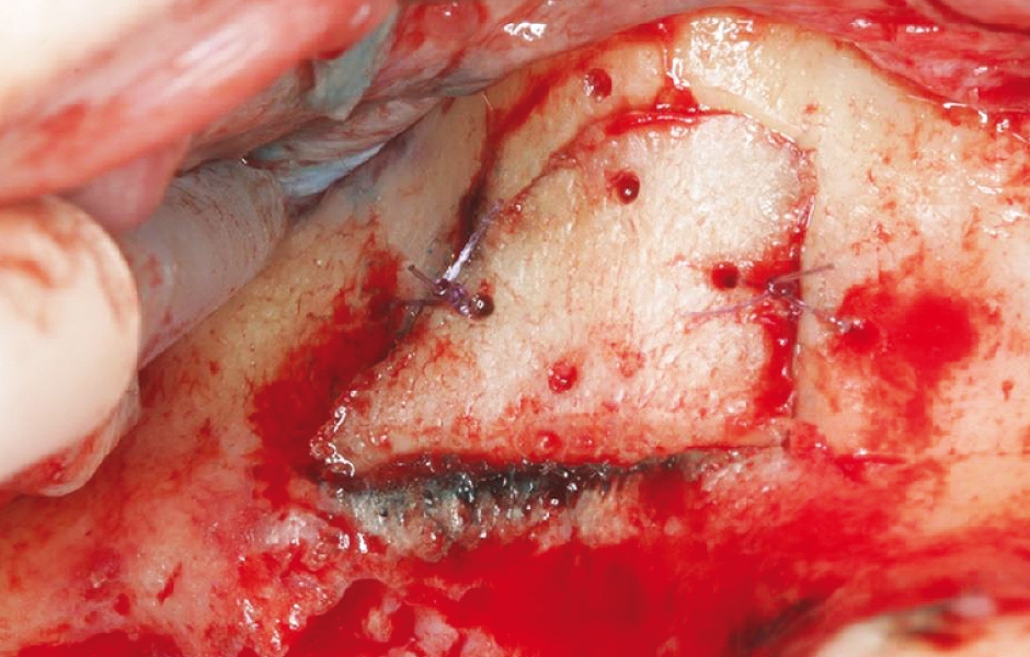 Obr. 10: Po vyčištění a dezinfekci byl kostní kryt znovu umístěn a fixován stehy 6-0.