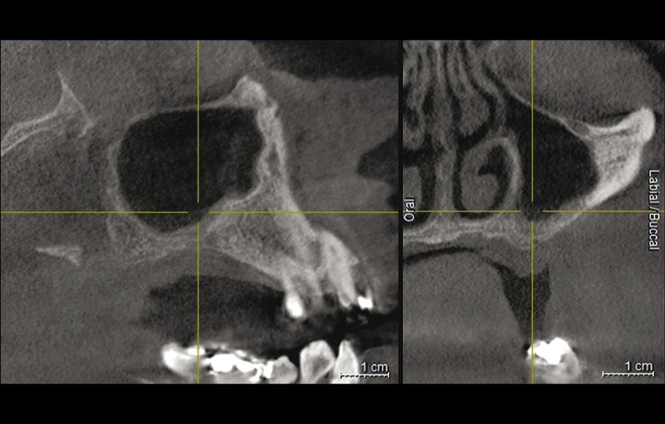 Obr. 11: Dva měsíce po výkonu, na CBCT snímku je vidět volný sinus s širokým přirozeným ústím.