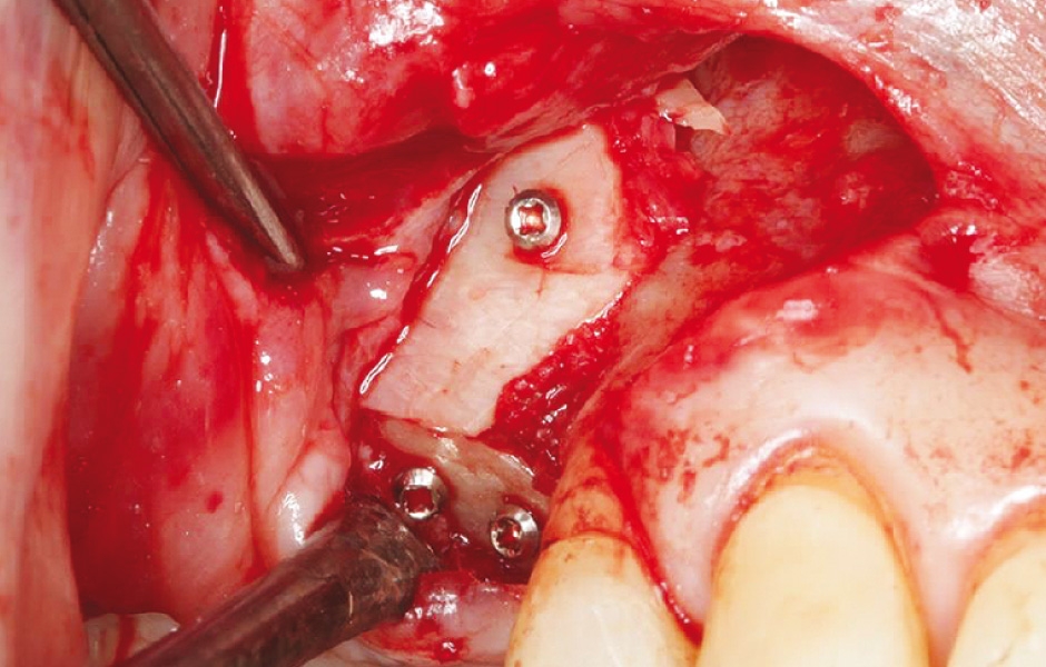 Obr. 12: Po získání kostěného štěpu z pravé mandibuly byla provedena trojrozměrná augmentace maxily pomocí jediné vertikální incize (tunelová technika).