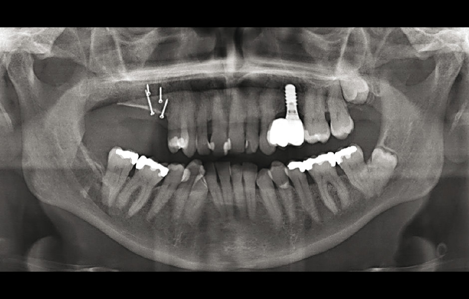Obr. 13: Panoramatický snímek ukazuje úspěšnou vertikální augmentaci až na výšku alveolární kosti sousedních zubů.