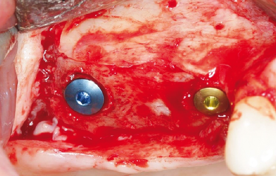 Obr. 14: Tři měsíce po augmentaci byly úspěšně zavedeny dva implantáty.