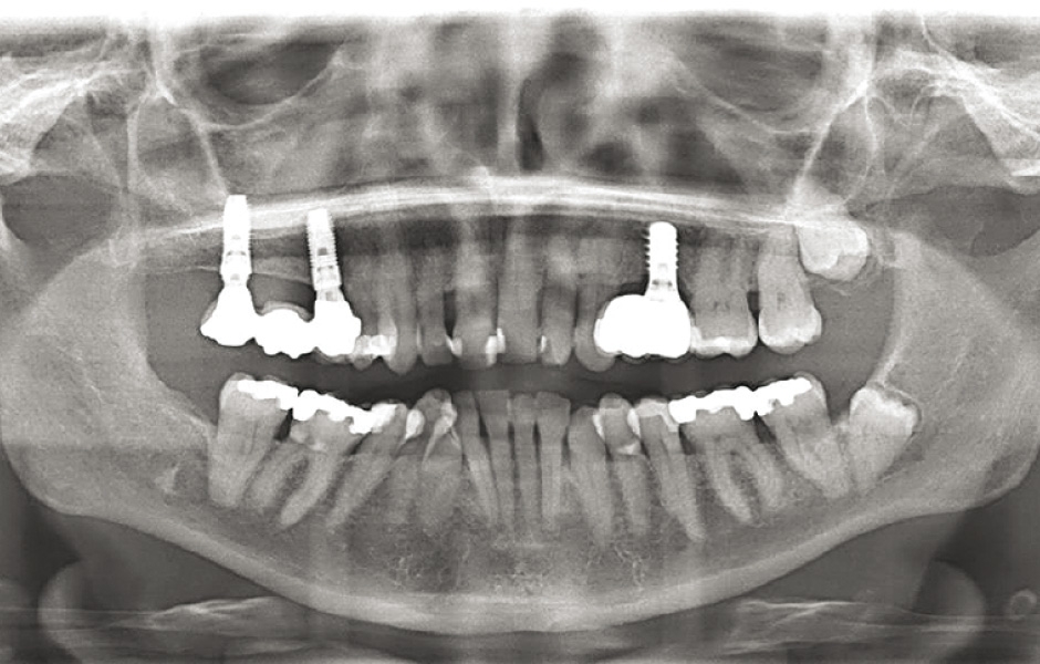 Obr. 15: Panoramatický snímek po 5 letech: implantáty proteticky ošetřeny, oblast stabilní.