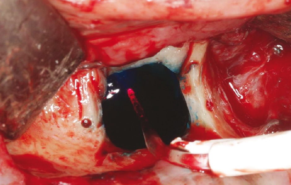 Obr. 4: Po debridementu provedena fotodynamická dekontaminace laserem HELBO.