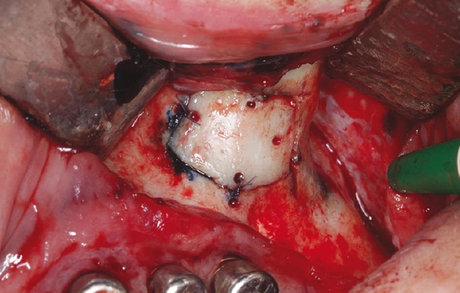 Obr. 5: Kostní víčko bylo znovu umístěno a původní implantáty odstraněny pro pokročilou periimplantitidu.