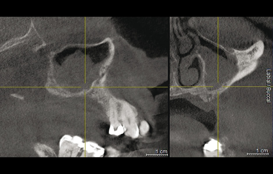 Obr. 7: CBCT: částečné zastínění pravého maxilárního sinu po neúspěšném sinus liftu s bovinním kostním náhradním materiálem.
