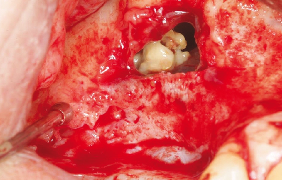 Obr. 8: Po odklopení kostní lamely patrná zelenošedá masa vyplňující velkou část lumen antra.