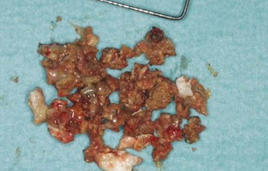 Obr. 9: Po odklopení kostní lamely patrná zelenošedá masa vyplňující velkou část lumen antra.