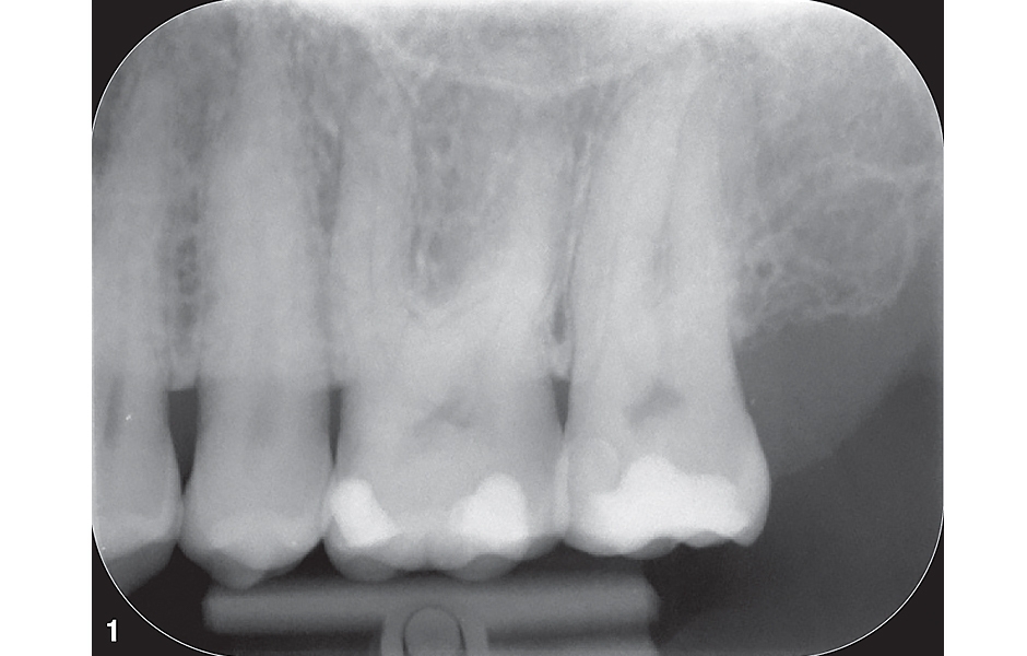 Obr. 1: Předoperační rentgenový snímek zubu 27.