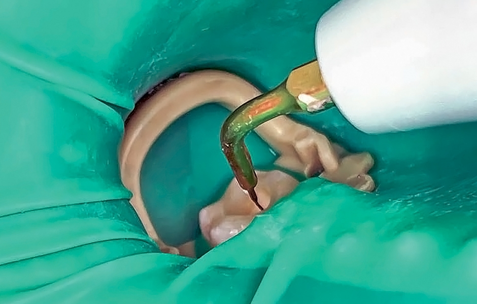 Obr. 3: Ultrazvukově aktivovaná irigace.