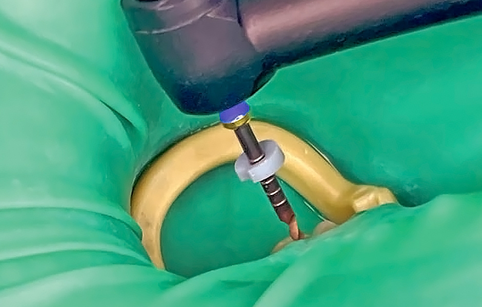 Obr. 5: Preparace bezdrátovým endomotorem CanalPro X-Move.