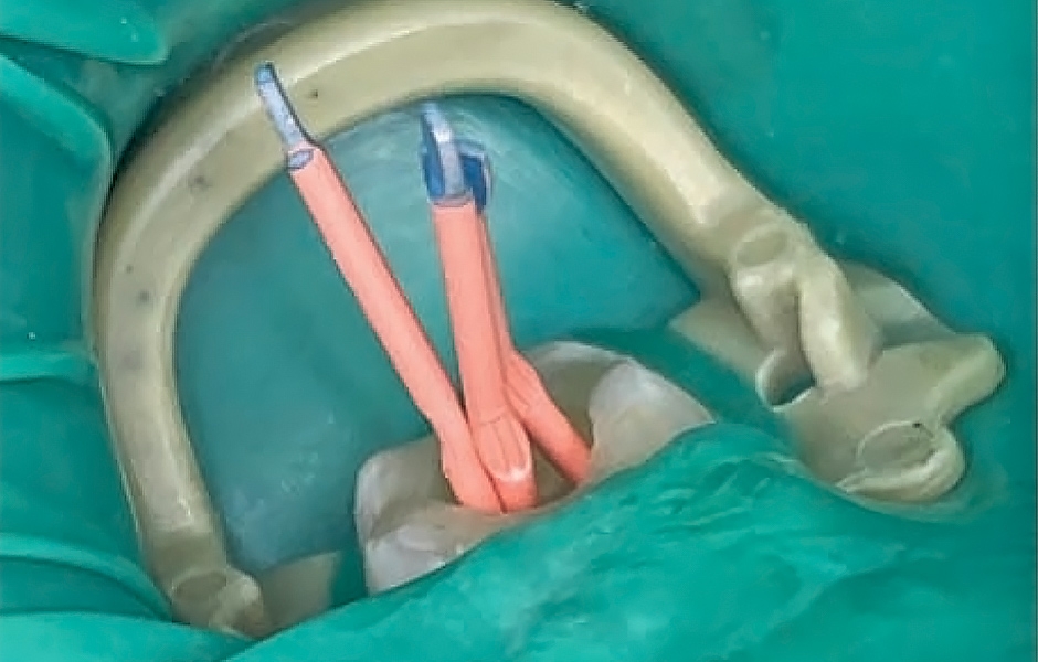 Obr. 6a–c: Zavedení centrálních gutaperčových čepů HyFlex EDM 30/.04. a) intraorální pohled, b) rentgenový snímek, c) jednotlivé gutaperčové čepy.