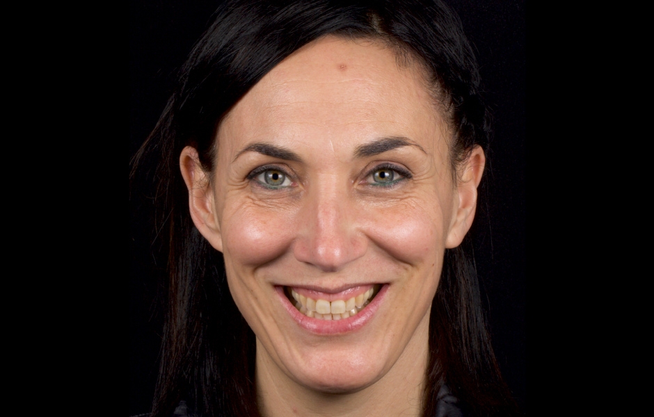 Obr. 1: Výchozí stav s gummy smile neboli nadměrným obnažením gingivy.