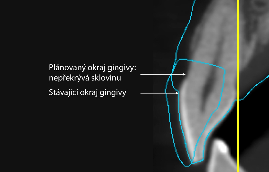 Obr. 3: Laterální pohled na okraj wax-upu