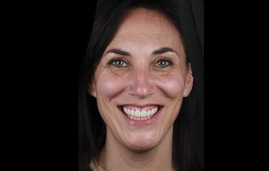 Obr. 4: Mock-up pro zhodnocení okluze a estetiky