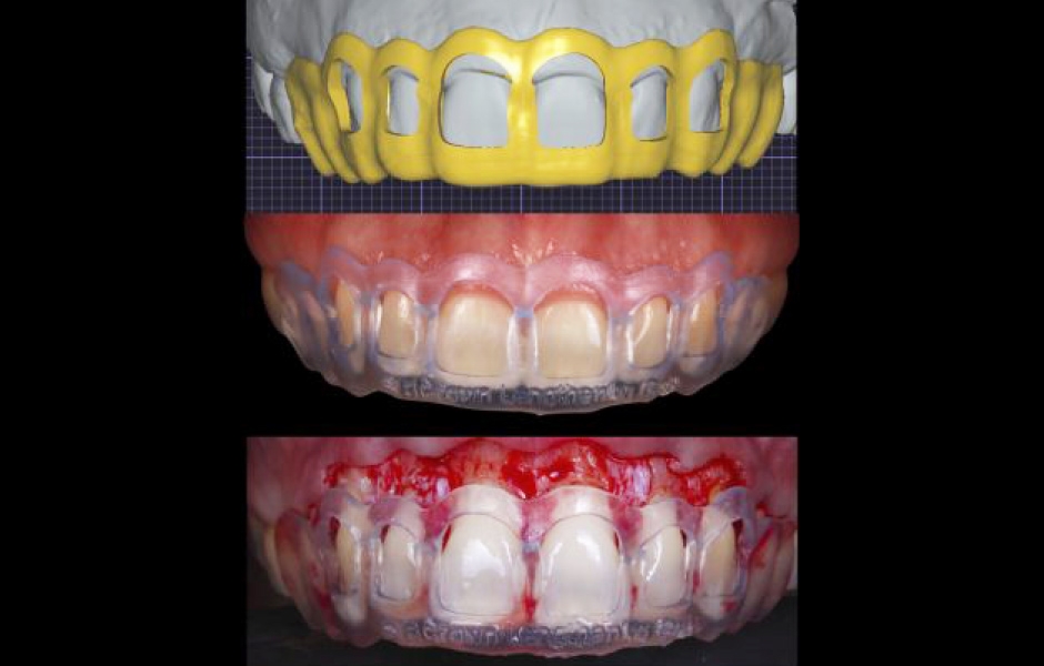 Obr. 5a–c: 3D tištěná chirurgická šablona