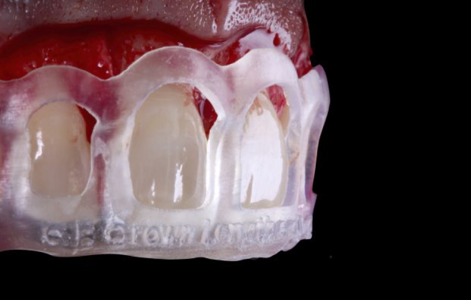 Obr. 6: Detailní pohled na šablonu s odklopeným lalokem