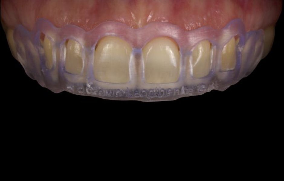 Obr. 7: Pooperační kontrola prokazující stabilitu výsledku chirurgického prodloužení klinické korunky zubů.