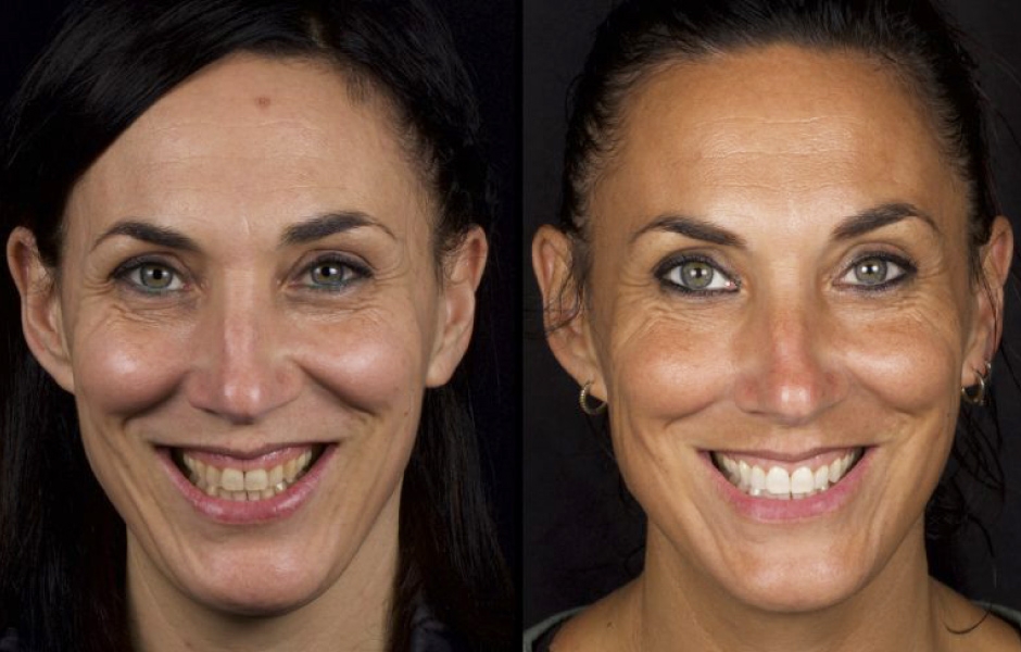 Obr. 9a: Výchozí situace před léčbou. Obr. 9b: Stav šest měsíců po chirurgickém zákroku a dva měsíce po bělení