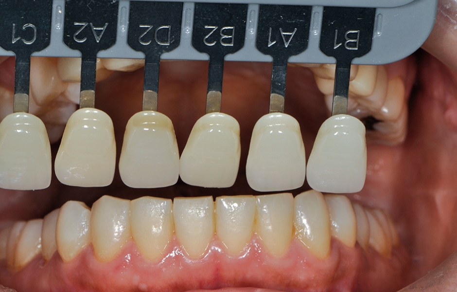 Obr. 26: Výběr odstínu podle přirozených zubů pacienta v dolní čelisti.