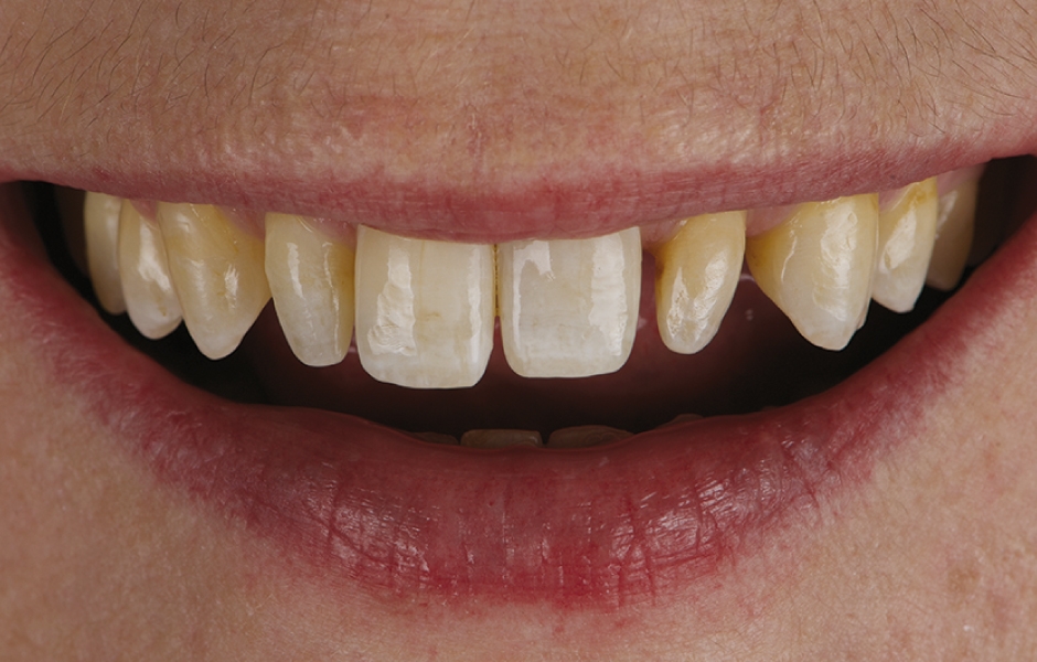 Obr. 1: Pacientka se dostavila s převážně intaktním chrupem, dobrou úrovní ústní hygieny a střední linií úsměvu.