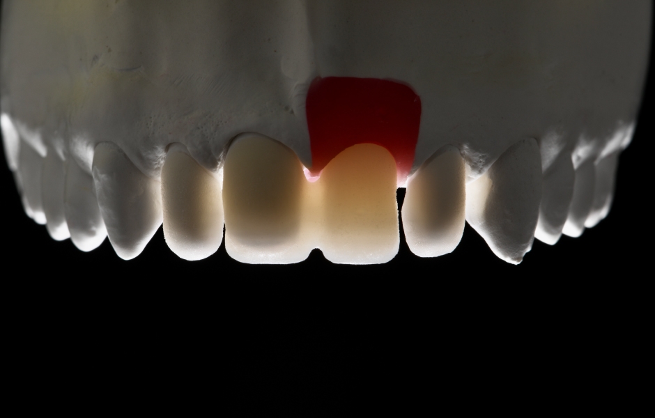 Obr. 10: Různé lithium-disilikátové a zirkoniové rekonstrukce na modelu před finálním fazetováním.