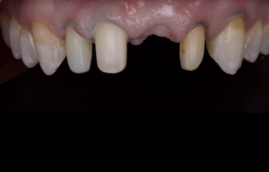 Obr. 11: Zuby byly preparovány pomocí silikonových klíčů připravených na základě diagnostického wax-upu, aby byl zajištěn dostatečný prostor pro definitivní rekonstrukce při minimálně invazivním přístupu.