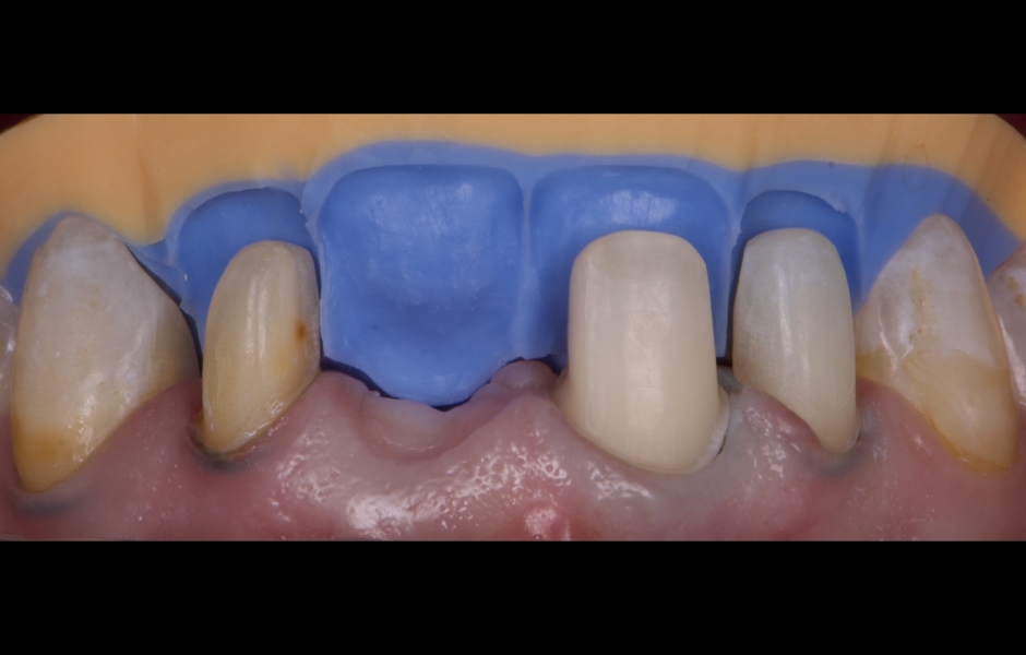 Obr. 12: Zuby byly preparovány pomocí silikonových klíčů připravených na základě diagnostického wax-upu, aby byl zajištěn dostatečný prostor pro definitivní rekonstrukce při minimálně invazivním přístupu.