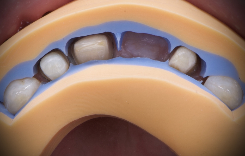 Obr. 13: Zuby byly preparovány pomocí silikonových klíčů připravených na základě diagnostického wax-upu, aby byl zajištěn dostatečný prostor pro definitivní rekonstrukce při minimálně invazivním přístupu.