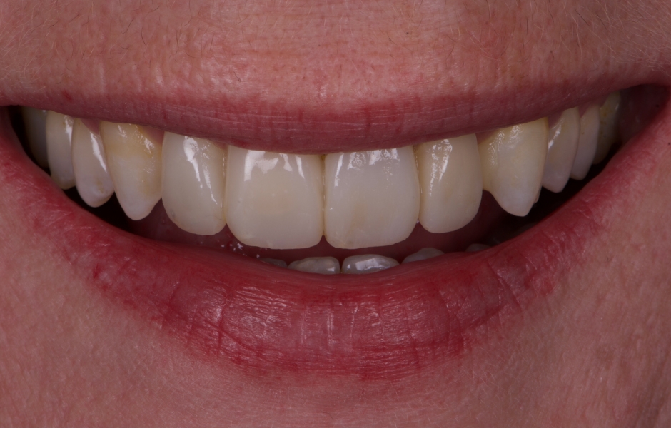 Obr. 14: Definitivní otisky byly sejmuty polyvinylsiloxanem (PVS) a provizorní rekonstrukce byly následně upraveny podle potřeby.