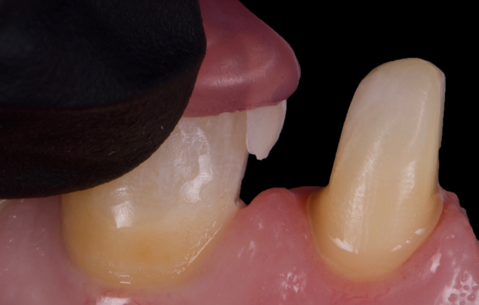 Obr. 15: Finální keramické rekonstrukce byly intraorálně zkontrolovány s ohledem na přesnost okrajového uzávěru, tvaru a estetiky. Adhezivní fixace byla provedena pomocí Variolink Esthetic DC.