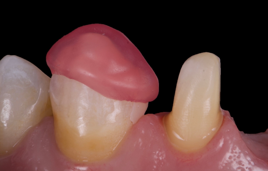 Obr. 16: Finální keramické rekonstrukce byly intraorálně zkontrolovány s ohledem na přesnost okrajového uzávěru, tvaru a estetiky. Adhezivní fixace byla provedena pomocí Variolink Esthetic DC.