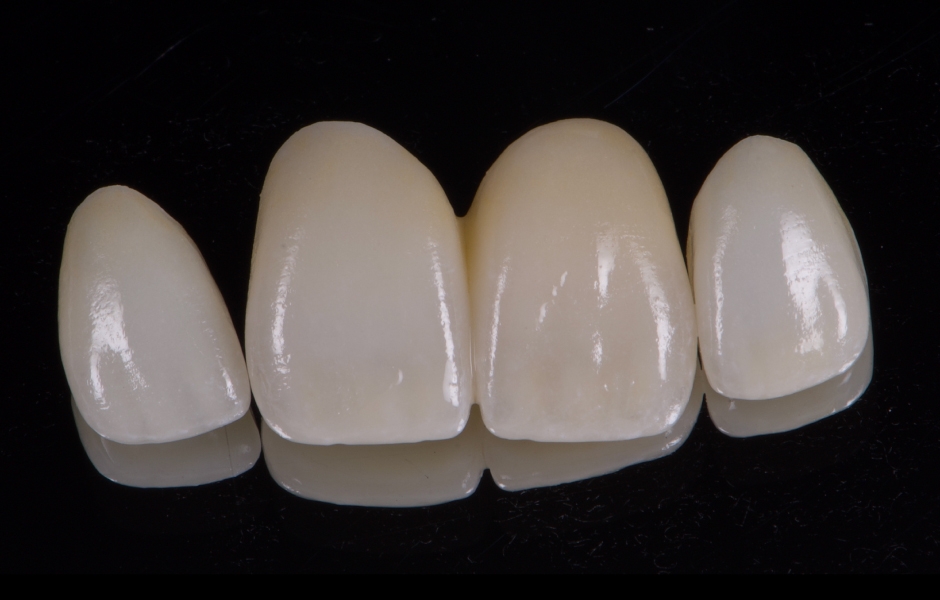 Obr. 17: Finální keramické rekonstrukce byly intraorálně zkontrolovány s ohledem na přesnost okrajového uzávěru, tvaru a estetiky. Adhezivní fixace byla provedena pomocí Variolink Esthetic DC.