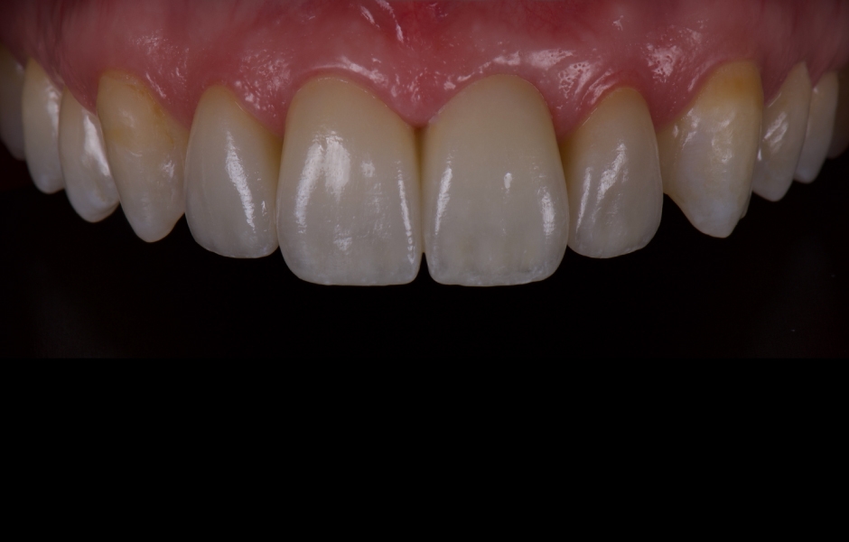Obr. 18: Finální keramické rekonstrukce byly intraorálně zkontrolovány s ohledem na přesnost okrajového uzávěru, tvaru a estetiky. Adhezivní fixace byla provedena pomocí Variolink Esthetic DC.