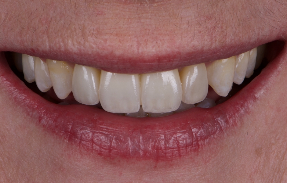 Obr. 19: Finální keramické rekonstrukce byly intraorálně zkontrolovány s ohledem na přesnost okrajového uzávěru, tvaru a estetiky. Adhezivní fixace byla provedena pomocí Variolink Esthetic DC.