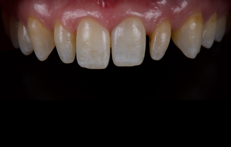 Obr. 2: Pacientka se dostavila s převážně intaktním chrupem, dobrou úrovní ústní hygieny a střední linií úsměvu.